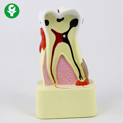 مدل دندانهای دندانپزشکی مقایسه پوسیدگی / مدلهای نمایشی دندانپزشکی برای آموزش